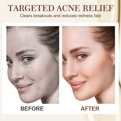 Multi-Effect Soothing Acne Treatment Cream